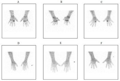 A comparison of Tc-99m tilmanocept radiopharmaceutical uptake on planar imaging in subjects with active rheumatoid arthritis (A: 200 µg tilmanocept/10 mCi Tc-99m; B-C: 400 µg tilmanocept/10 mCi Tc-99m) versus healthy controls (D-F: 400 µg tilmanocept/10 mCi Tc-99m) at three hours post-IV administration. Image courtesy of Dr. Arash Kardan et al, University Hospitals/Case Western Reserve University, Cleveland, OH.