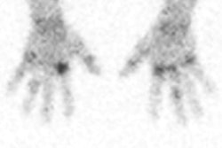 2019 06 23 21 52 0990 2019 06 24 Rheumatoid Arthritis 20190623220259