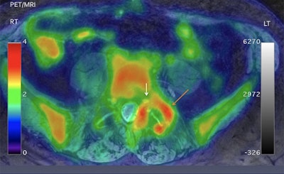 Axial projection of a 57-year-old male with low back pain down to the left groin, leg, and foot. Significant asymmetric uptake of FDG is seen around the left facet joint (orange arrow; SUVmax 2.94), compared with the right facet joint (SUVmax 1.2). Increased tracer uptake is adjacent to left foraminal segment of the left nerve root (white arrow). Images courtesy of Biswal et al and SNMMI.