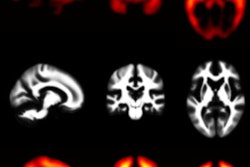 2019 06 25 01 00 3664 Snmmi Pi B Pet Down Syndrome Alzheimers 20190625011837