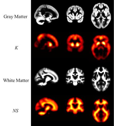 PiB-PET images display Down syndrome-specific templates for carrying capacity (K) and nonspecific Down syndrome (NS) binding. Maps of gray and white matter are displayed for visual reference. K images represent the theoretical limit for the Down syndrome brain to carry beta-amyloid plaques and are in strong agreement with known spatial distribution of plaques in Down syndrome. The highest values are located in the striatum and precuneus. Images courtesy of Zammit et al and SNMMI.