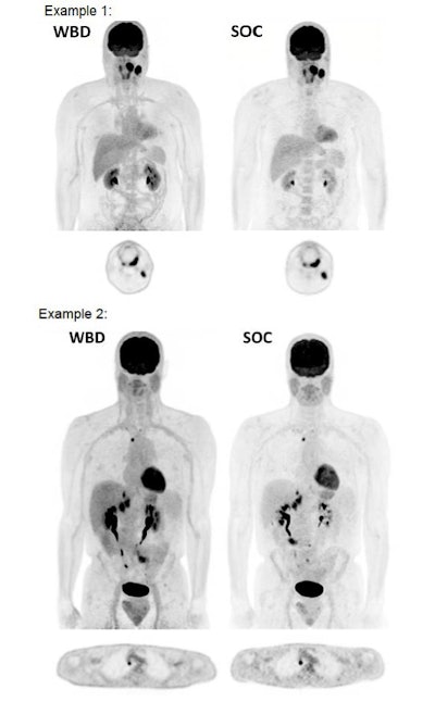 Maximum intensity projection and transaxial whole-body dynamic (WBD) images and standard-of-care (SOC) images were deemed comparable for cases of head and neck cancer in example 1 and lung cancer in example 2. Images courtesy of Cho et al and SNMMI.