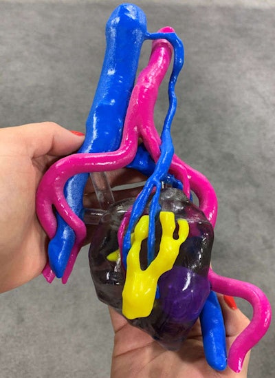 3D-printed kidney model containing a tumor (purple), aorta and iliac and renal arteries (pink), veins (blue), and the collecting duct system (yellow). Image courtesy of Nicole Wake, PhD.