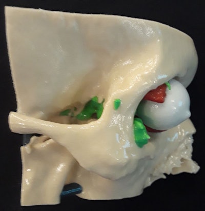3D-printed craniofacial model depicting part of a skull (beige), a multicentric tumor (green), eye (white), and extraocular muscles (red). Model courtesy of Dr. Edward Quigley, PhD.