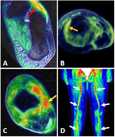 PET/MR images show high FDG uptake in dorsal foot muscle (A, red arrow); in thickened subcutaneous tissues (B, orange); on the tibial nerve surrounded by scar tissue (C, yellow arrow); and globally increased FDG uptake on femoral, popliteal, and tibial neurovascular bundles (D, white arrow). Images courtesy of Yoon et al and SNMMI.
