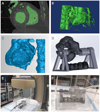 Creation process for a 3D anatomical heart and spine model, from a CT scan (A) to a virtual 3D reconstruction (B, C, D) to a 3D-printed model (E, F). Image courtesy of Liu et al. Licensed under CC BY 4.0.