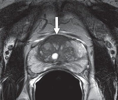 MR images are from a 65-year-old man with increasing prostate-specific antigen (PSA) level of 6.7 ng/mL and negative findings on TRUS-guided biopsy performed two years earlier. An axial T2-weighted MR image (above) shows nonencapsulated homogeneous triangular 1.9-cm focus (arrow) of reduced T2 signal in midline anterior transition zone. Axial oblique T2-weighted MR image (below) acquired in plane of needle introducer after needle deployment during direct MRI-guided biopsy shows needle (arrows) traversing target. Images courtesy of AJR.