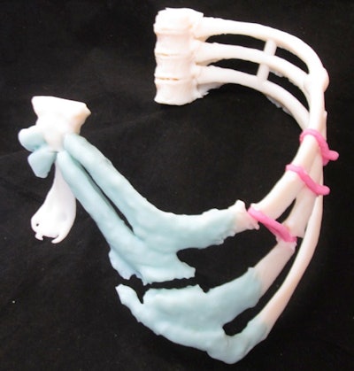 3-D Printer Uses Metal To Make Custom Rib Cage For Cancer Patient