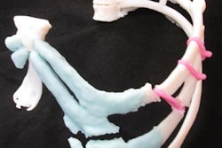 2019 07 23 23 54 5580 3 D Printed Chest Wall 600 20190723234202