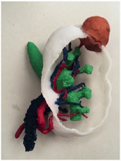 3D-printed kidney based on patient CT scans. The model displays the segmental arteries and veins (red, blue), renal pelvis (green), and renal mass (salmon pink). Image courtesy of Fan et al. Licensed under CC BY-NC 4.0.