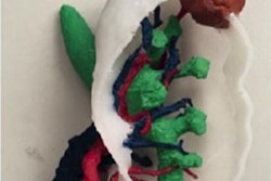 2019 07 25 18 49 2811 3 D Printed Kidney Cancer 400 20190725181759