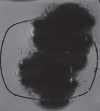 Magnetic eyelashes caused an artifact that consumed much of this susceptibility-weighted MR image (above). By comparison, artifacts caused by three aneurysm clips (below) were similar but much smaller than the distortions from the magnetic lashes. Images courtesy of AJR.