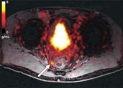 Axial Ga-68 PSMA-fused PET/MR image shows abnormal radiotracer uptake (arrow) within rounded right mesorectal lymph node. Transrectal biopsy findings were negative for malignancy. Patient underwent androgen deprivation therapy. Image courtesy of AJR.