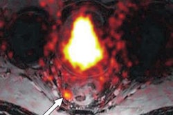 2019 07 29 20 00 1193 Ga68 Psma Pet Mri Prostate Ajr Lighter 20190729200522