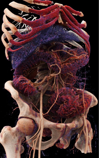 Cinematically rendered CT scan of a patient with ulcerative colitis. Image courtesy of Dr. Qinqing Li.