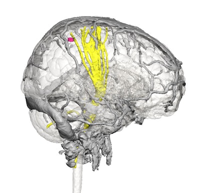 A virtual 3D model based on brain MR images (above). A patient-specific 3D-printed brain (below). All images courtesy of Jayanthi Parthasarathy, PhD.