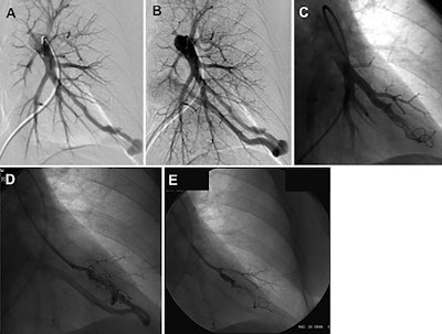 Images in a 52-year-old woman with HHT demonstrating on left pulmonary artery angiogram an AVM at the left base (A, B). Selective angiogram after embolization of the AVM by using coils (C). Angiogram shows embolization for persistence treated with repeat embolization performed two years after initial embolization (D, E). Images courtesy of RSNA.