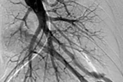 2019 07 31 00 38 6999 Smoking Embolization 600 20190731000711