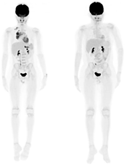 FDG-PET images are from a 12-year-old male diagnosed with clinical stage II non-Hodgkin's lymphoma. Staging PET image (left) shows no lymphoma lesions outside the regular field-of-view. Interim PET image (right) shows a complete metabolic response after two cycles of chemotherapy. Patient was disease-free at 12-month follow-up. Images courtesy of JNM.