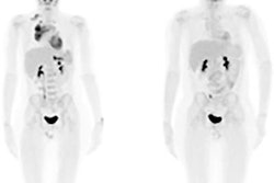 2019 08 02 23 38 3822 Pet Ct Field View Lymphoma 20190802232440