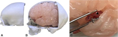 Patient-specific 3D-printed model for neurosurgery simulation, including a 3D-printed skull, brain, and artery with an aneurysm (arrowhead).