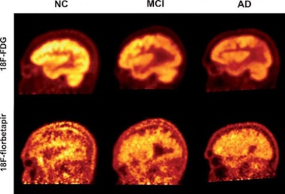 PET imaging using FDG and florbetapir to quantify cognitive decline in patients with Alzheimer's disease (AD), mild cognitive impairment (MCI), and healthy controls (NC). Image courtesy of Penn Medicine.