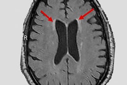 2019 08 13 20 08 4298 Mri White Matter Lesions 20190813205845