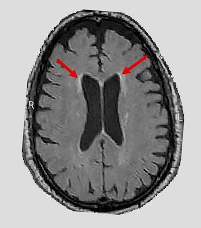 The SPRINT MIND study found a link between blood pressure and accumulation of white-matter lesions (arrows) on brain MRI scans. Image courtesy of the SPRINT MIND investigators and the NIH.