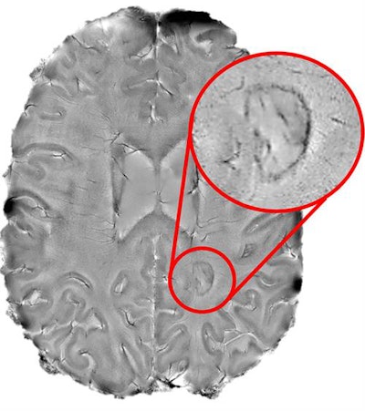 Chronic active lesions that appear as dark-rimmed spots (red circle) on brain MRI scans indicate 'smoldering' inflammation, a sign of debilitating multiple sclerosis. Image courtesy of the NINDS Reich lab.