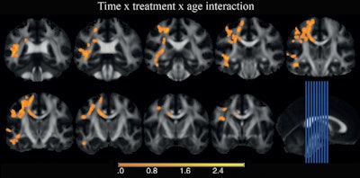 Voxelwise fractional anisotropy analysis shows significant changes relative to age and MHP treatment. Coronal sections (left) correspond to the sagittal section locations in the image in the bottom row far right. The areas in which the difference between baseline and after treatment in children treated with methylphenidate are greater than adults treated with the drug are color coded orange. They are located in parts of the left superior longitudinal fasciculus, inferior longitudinal fasciculus, inferior fronto-occipital fasciculus, and the corpus callosum truncus. Images courtesy of Radiology.