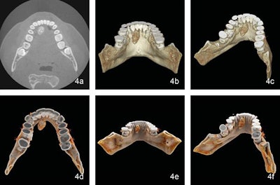 Patient with a salivary gland stone visualized with axial conebeam CT (a), conventional volume-rendering reconstruction of conebeam CT scans (b, c), and cinematic rendering of conebeam CT scans (d-f). Image courtesy of Drs. Sebastian Winklhofer and Bernd Stadlinger.