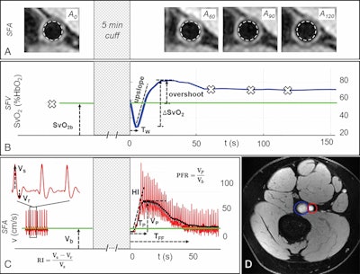 Response to cuff occlusion in the femoral circulation. A: Vessel-wall images of the superficial femoral artery (SFA) at different points (60 secs [A60], 90 secs [A90], and 120 secs [A120]) as indicated by crosses in B during reactive hyperemia. The dashed circles represent the lumen area at baseline. B: Superficial femoral vein (SFV) oxygen saturation (SvO2) at baseline (green line) and during hyperemia. C: SFA blood flow velocity (V). D: Axial image obtained with MRI in the thigh, with SFA and SFV indicated in red and blue, respectively. Δ SvO2 = peak-to-peak SvO2, HI = hyperemic index, PFR = peripheral flow reserve, RI = resistivity index, TFF = time of forward flow, TP = time to peak, TW = washout time, Vb = baseline velocity, VP = peak hyperemic velocity, Vr = retrograde velocity during early diastole, Vs = systolic velocity. Image courtesy of the RSNA.