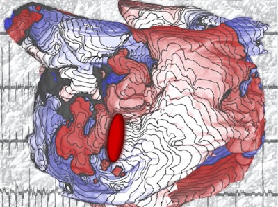 Depiction of a map from a 3D model of the heart atrium. Image courtesy of Patrick Boyle, PhD, and Natalia Trayanova, PhD, of Johns Hopkins University.