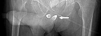Scout image from contrast-enhanced CT scan shows erectile implant. Stainless steel and silicone anchors (arrow) transfixed to pubic bone are asymmetric. Image courtesy of AJR.