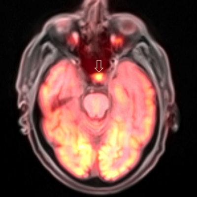 PET/MRI brain scan. Image courtesy of Dr. Ana Franceschi.