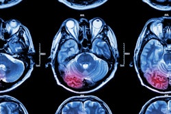 2018 10 18 20 42 6759 Stroke Mri 400