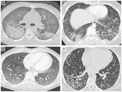 Chest CT scans showing diffuse alveolar damage in the lungs of a 20-year-old man (A), acute eosinophilic pneumonia in a 19-year-old woman (B), hypersensitivity pneumonitis in a 35-year-old man (C), and giant-cell interstitial pneumonia in a 49-year-old-woman (D). The symptoms of these patients improved after vaping cessation. Image courtesy of The New England Journal of Medicine ©2019.