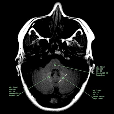 MR image from a 36-year-old female patient who received seven administrations of gadoterate meglumine. The mean dentate nucleus/pons ratio on T1-weighted spin echo increased from 1.09 at the first scan in July 2006 to 1.18 at her last scan in February 2010. Images courtesy of Splendiani et al and Insights into Imaging.