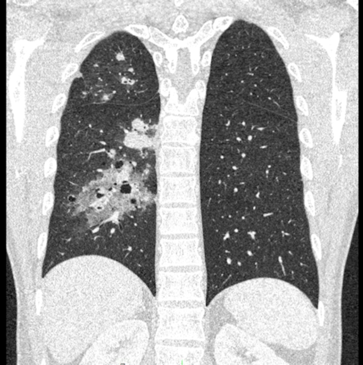 Clinical study validates ultrahigh-resolution chest CT