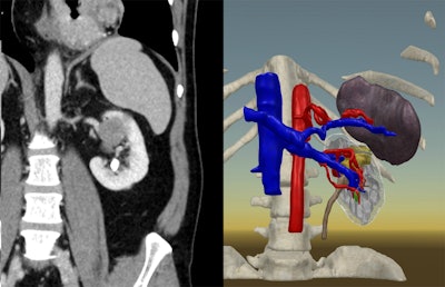 A 3D virtual reality kidney model (right) based on a patient's CT scan (left). All images courtesy of Dr. Joseph Shirk.