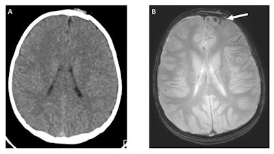 Axial nonenhanced CT (A) demonstrates no acute intracranial abnormality in a patient with left frontal calvarial fracture. Axial T2-weighted GRE MRI (B) reveals subarachnoid hemorrhage of the left frontal lobe (white arrow). Images courtesy of co-authors Drs. Daniel Lindberg and David Mirsky.