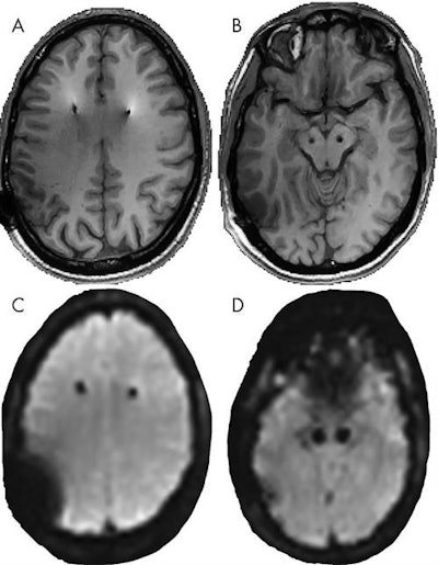 MR images show DBS device at 3 tesla. Axial 3D spoiled gradient-recalled images (A, B) and gradient-recalled echo-planar images (C, D) of patients receiving treatment show hardware artifact at the level of frontoparietal (A, C) and electrode contact (B, D). Images courtesy of Radiology.