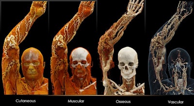 Cinematically rendered images based on patient CT scans viewed using different presets for skin, muscle, bone, and vasculature (from left to right). All images courtesy of Dr. Savvas Nicolaou.