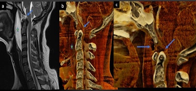 Comparable views of a ruptured tectorial and anterior atlanto-occipital membrane (arrow) seen on a spine MRI scan (a) and a cinematically rendered spine CT scan (b, c).