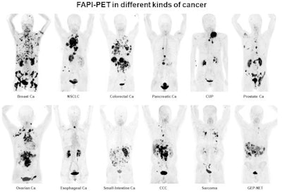 Ga-68 FAPI PET/CT shows 12 different tumor entities. Image courtesy of Kratochwil et al and SNMMI.