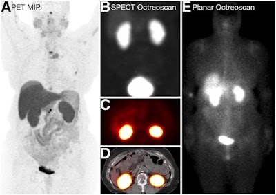 SSTR PET reflects higher Krenning scores than In-111 pentetreotide in low-volume disease. The patient was graded as having a Krenning score of 4 on SSTR PET (A) but 0 on SPECT (B, C, and D) and planar imaging (E). MIP = maximum-intensity projection. Images courtesy of JNM.