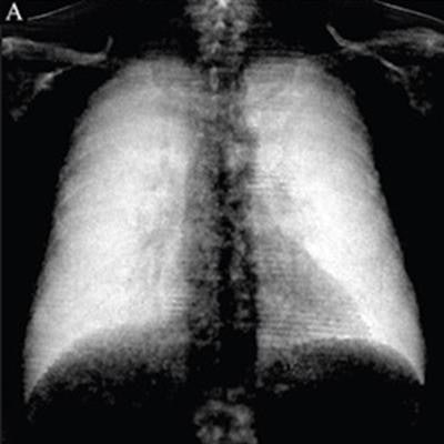 2022 01 12 21 42 0741 2021 01 13 Dark Field Chest X Ray Red 20220112214038