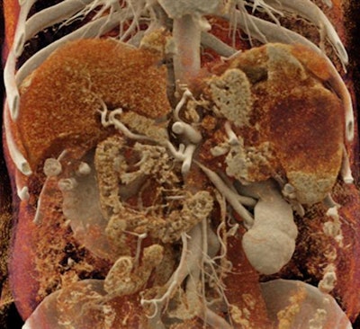 Cinematic rendering of an abdominal CT scan. Image courtesy of Dr. Elliot Fishman.