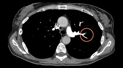 Aidoc's pulmonary embolism detection algorithm flags CT angiograms for urgent review. Image courtesy of Aidoc.