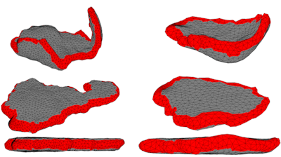 A 3D placenta model based on MRI scans in an in utero position (top) and after flattening (bottom). Image and video courtesy of MIT CSAIL.